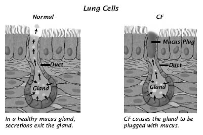 cystic_fibrosis